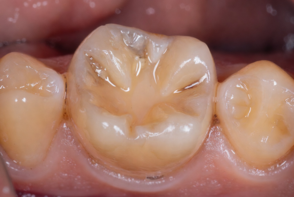Endodontia 3
