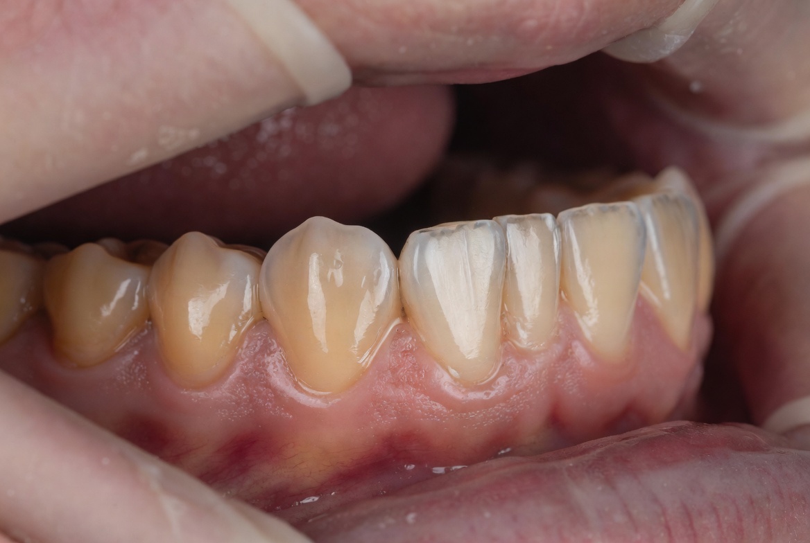 Prótese Dentária 1